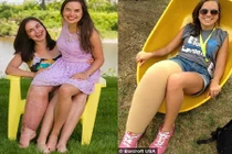 Cô gái “chân voi“ không ngại diện quần sooc, váy ngắn