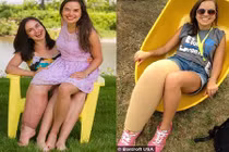 Cô gái “chân voi“ không ngại diện quần sooc, váy ngắn