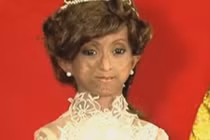 Bệnh lạ biến cô gái 18 tuổi thành cụ bà 144 tuổi