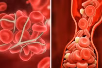 10 cách ngăn ngừa cục máu đông có thể cứu mạng sống