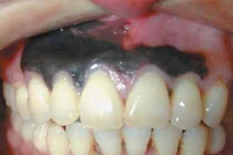 Mắc ung thư da hắc tố hiếm trong miệng