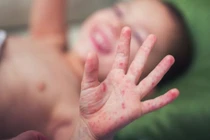 Trẻ bị tay chân miệng trở nặng do chủng vi rút nguy hiểm tái xuất 