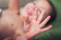 Trẻ bị tay chân miệng trở nặng do chủng vi rút nguy hiểm tái xuất 