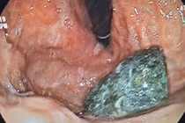 Thêm trường hợp tắc ruột kinh hoàng vì trà sữa