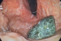 Thêm trường hợp tắc ruột kinh hoàng vì trà sữa