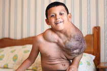 Cậu bé được điều trị khối u khổng lồ bằng Viagra