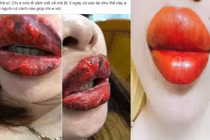 Hoảng hồn những ca biến chứng kinh hoàng vì phun xăm môi hỏng
