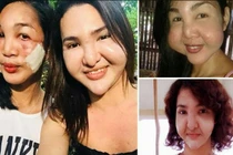 Thảm họa thẩm mỹ khiến cặp bạn thân người Phillippines biến dạng khuôn mặt