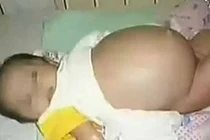 Nhiều bí ẩn chưa biết về hiện tượng trẻ sơ sinh mang thai