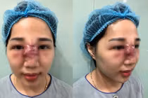 Kinh hoàng những ca hoại tử do nâng mũi từ đầu năm