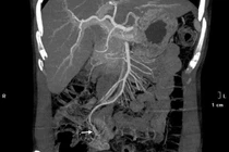 Suýt mất mạng vì chủ quan khi đại tiện phân đen
