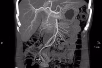 Suýt mất mạng vì chủ quan khi đại tiện phân đen