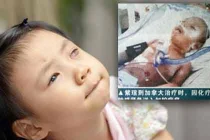 Thương tâm bé gái mù 2 mắt vì ung thư