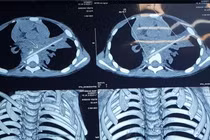Bé 5 tuổi viêm phổi ròng rã 8 tháng liền: Thủ phạm là que xiên thịt nướng