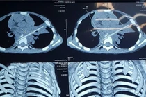 Bé 5 tuổi viêm phổi ròng rã 8 tháng liền: Thủ phạm là que xiên thịt nướng