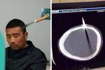 Bị dao găm vào não, vẫn bình thản đi bộ tới viện 