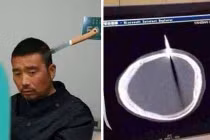 Bị dao găm vào não, vẫn bình thản đi bộ tới viện 