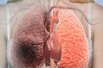 Bổ sung thực phẩm làm sạch phổi tránh ung thư như diễn viên Mai Phương