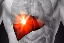 Có dấu hiệu này chứng tỏ bạn đang bị gan nhiễm mỡ