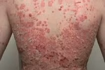 Bệnh vảy nến, viêm da cơ địa tăng do ảnh hưởng của thực phẩm