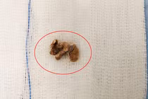 Bé gái nhét dị vật trong “vùng kín”: Dạy trẻ tránh tái phạm