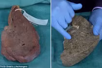 Ám ảnh lá gan đen sì của người chết vì xơ gan do uống rượu 