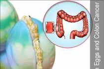 Trứng thối thúc đẩy tế bào ung thư đại tràng tăng trưởng