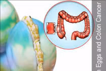 Trứng thối thúc đẩy tế bào ung thư đại tràng tăng trưởng