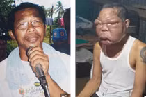 Mặt biến dạng, phình to gấp 3 lần bình thường vì bệnh lạ