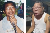 Mặt biến dạng, phình to gấp 3 lần bình thường vì bệnh lạ