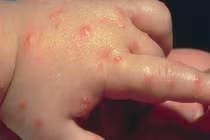 Mẹ thông thái hãy bỏ túi cách phân biệt các nốt côn trùng cắn