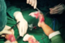 Máy cắt cỏ nhà hàng xóm cắt nát hai bàn chân bé 2 tuổi