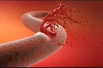 Hết sức thận trọng với những dấu hiệu cơ thể bị chảy máu trong