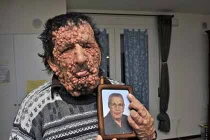 Biến dạng kinh hoàng vì khối u