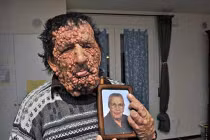 Biến dạng kinh hoàng vì khối u