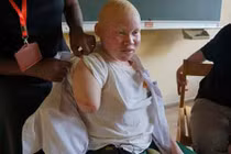 Cô gái bạch tạng bị chặt tay để làm thuốc phù thủy