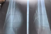 Kinh hoàng góa phụ “mọc” hàng chục cây kim từ... bắp chân 