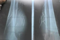 Kinh hoàng góa phụ “mọc” hàng chục cây kim từ... bắp chân 