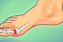 Tuyệt chiêu giảm đau hiệu quả cho người mắc bệnh gout