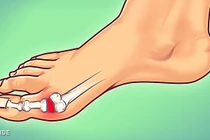 Tuyệt chiêu giảm đau hiệu quả cho người mắc bệnh gout