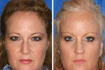 So sánh tác hại của thuốc lá trên cặp song sinh