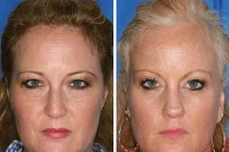 So sánh tác hại của thuốc lá trên cặp song sinh