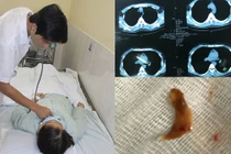 Cô gái ăn thịt vịt, xương đi lạc trong người 3 tháng