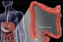 Những điều cần biết về ung thư đại tràng (1)