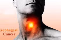  Bốn thói quen ăn uống gây ung thư thực quản 