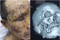 Kinh hoàng những ca cấp cứu tai nạn hy hữu từ đầu năm