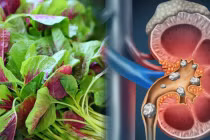 8 loại rau củ là bể chứa axit oxalic, gây tăng nguy cơ mắc sỏi thận