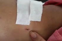 Khoan nhầm cẳng chân bệnh nhân, hai nhân viên bệnh viện Chợ Rẫy bị đình chỉ