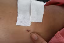 Khoan nhầm cẳng chân bệnh nhân, hai nhân viên bệnh viện Chợ Rẫy bị đình chỉ