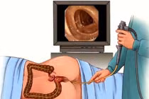 Tầm soát ung thư đại tràng giúp giảm tử vong